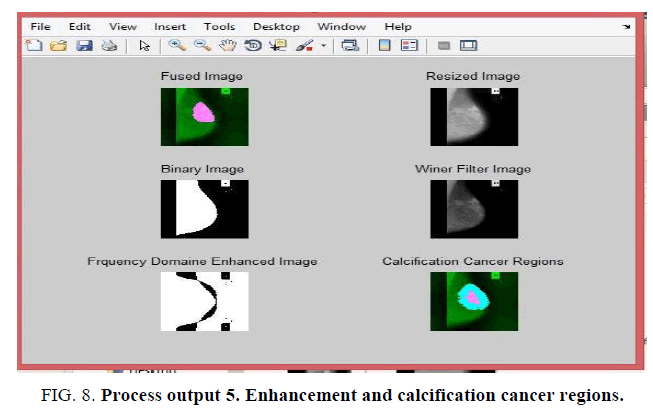 biotechnology-Enhancement-calcification-cancer-regions