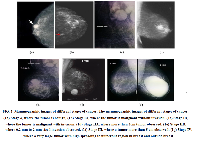biotechnology-Mammographic-images-stages-cancer